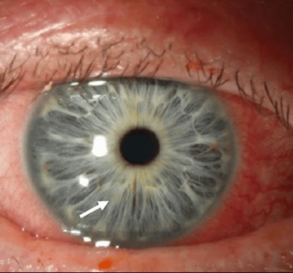 Corneal Ulcer ABDO