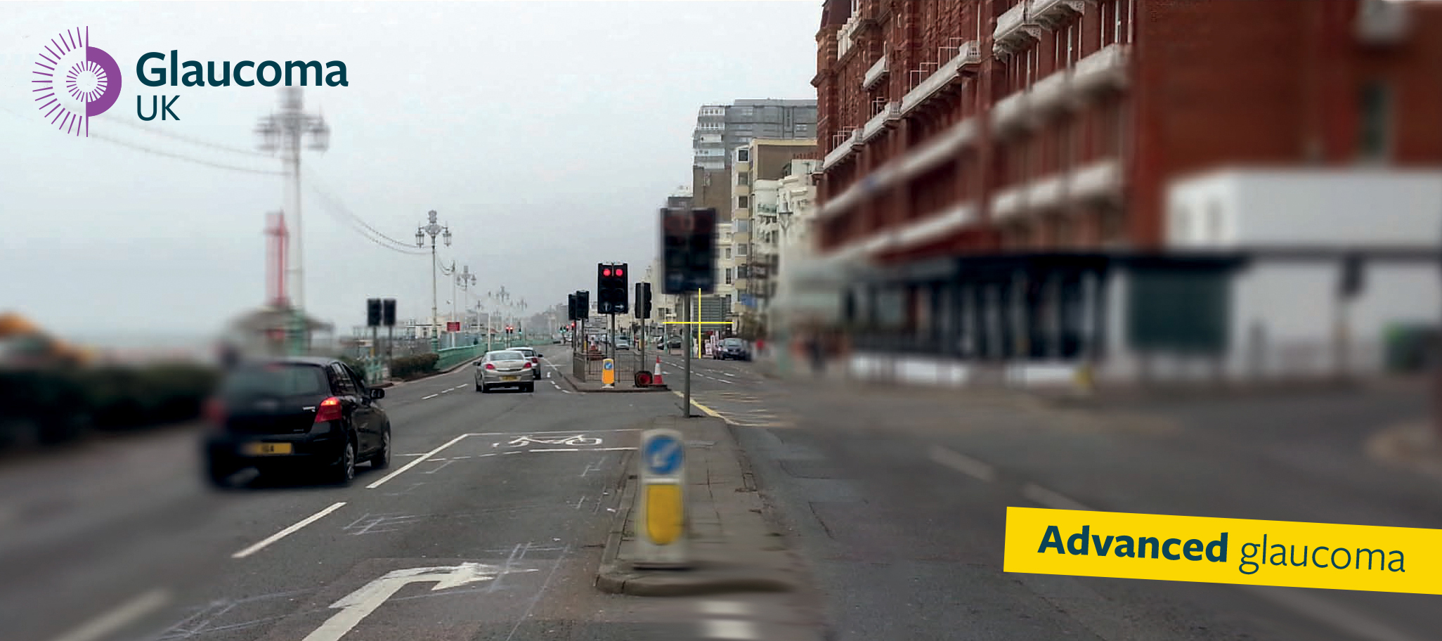Advanced glaucoma